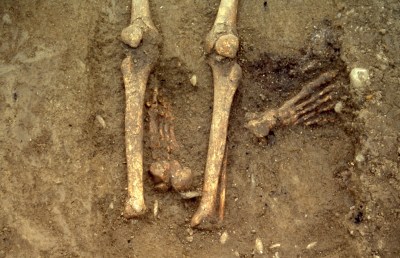 Le evidenti amputazioni dei piedi all'inumato della Tomba 16 di et tardoantica rinvenuta a Casalecchio di Reno (BO)